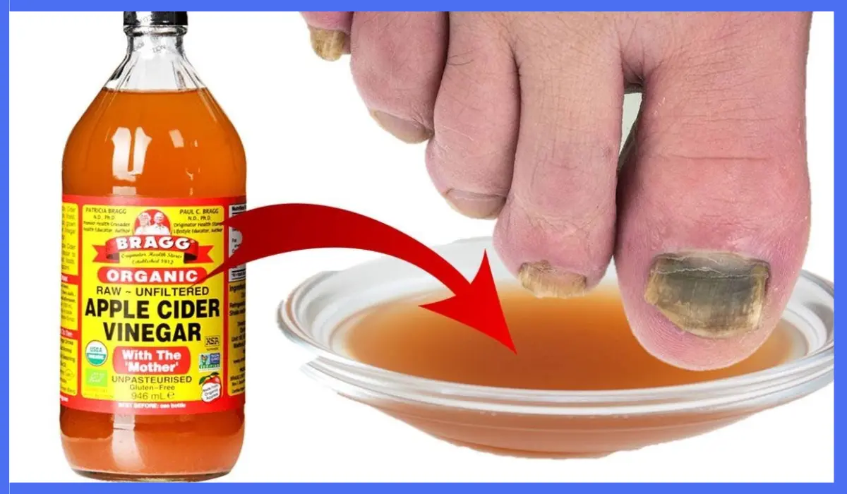 Apple Cider Vinegar For Toenail Fungus