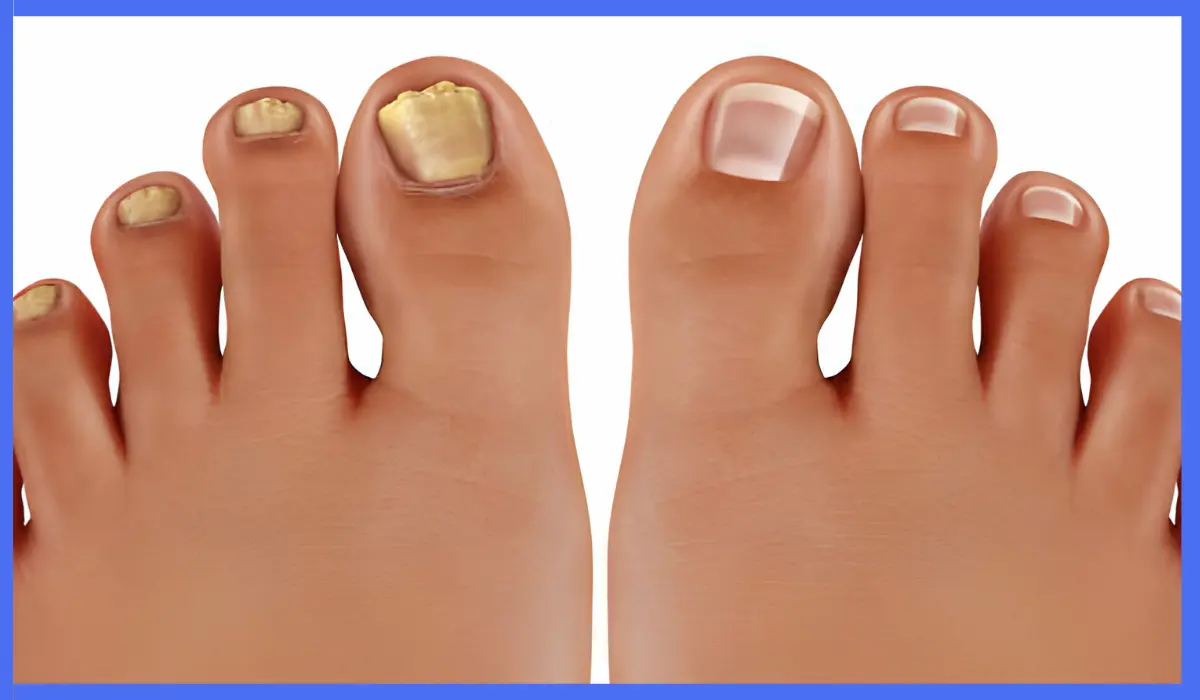 Can Toenail Fungus Kill You