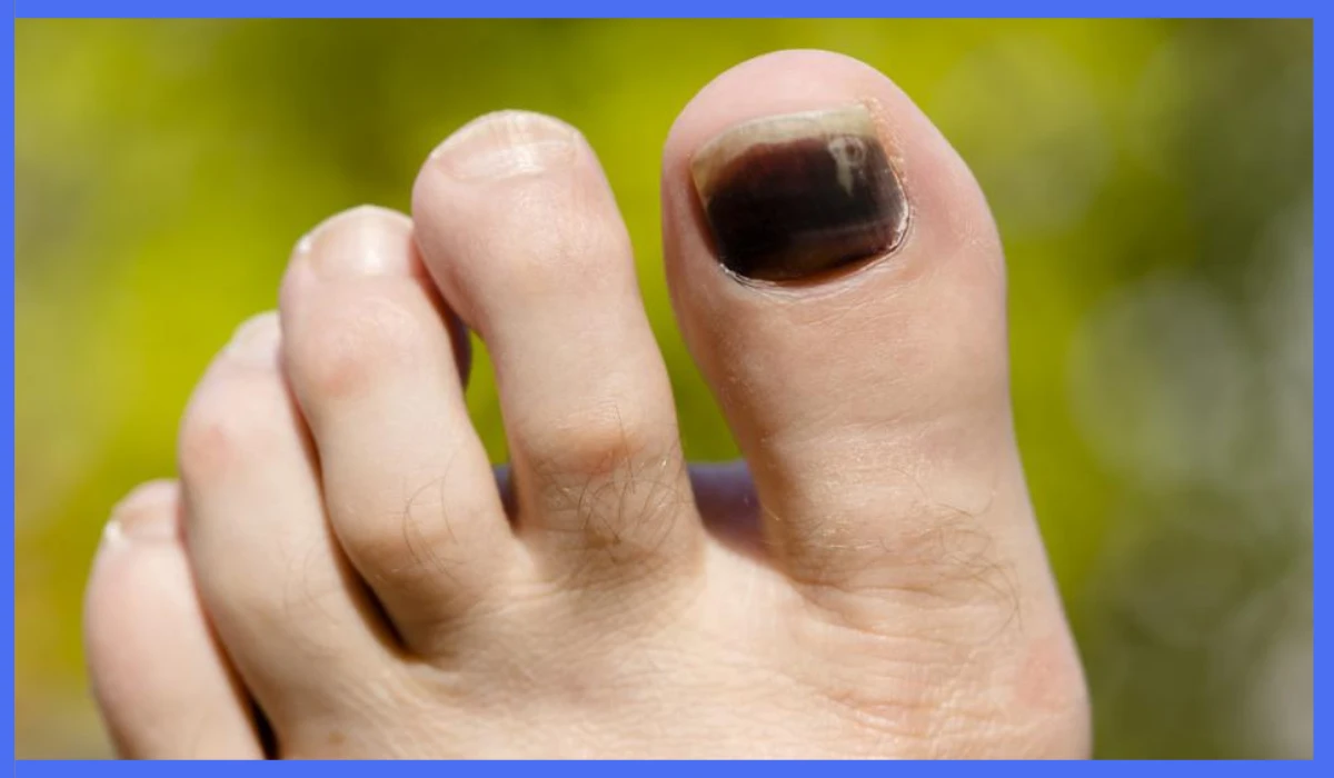 Causes Of Black Toenail Fungus