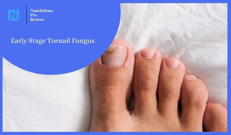 Understanding Early Stage Toenail Fungus: Signs, Symptoms, And Treatment