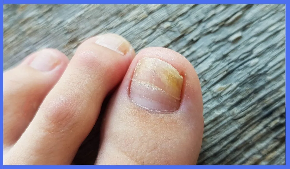 Early Stage Toenail Fungus Symptoms