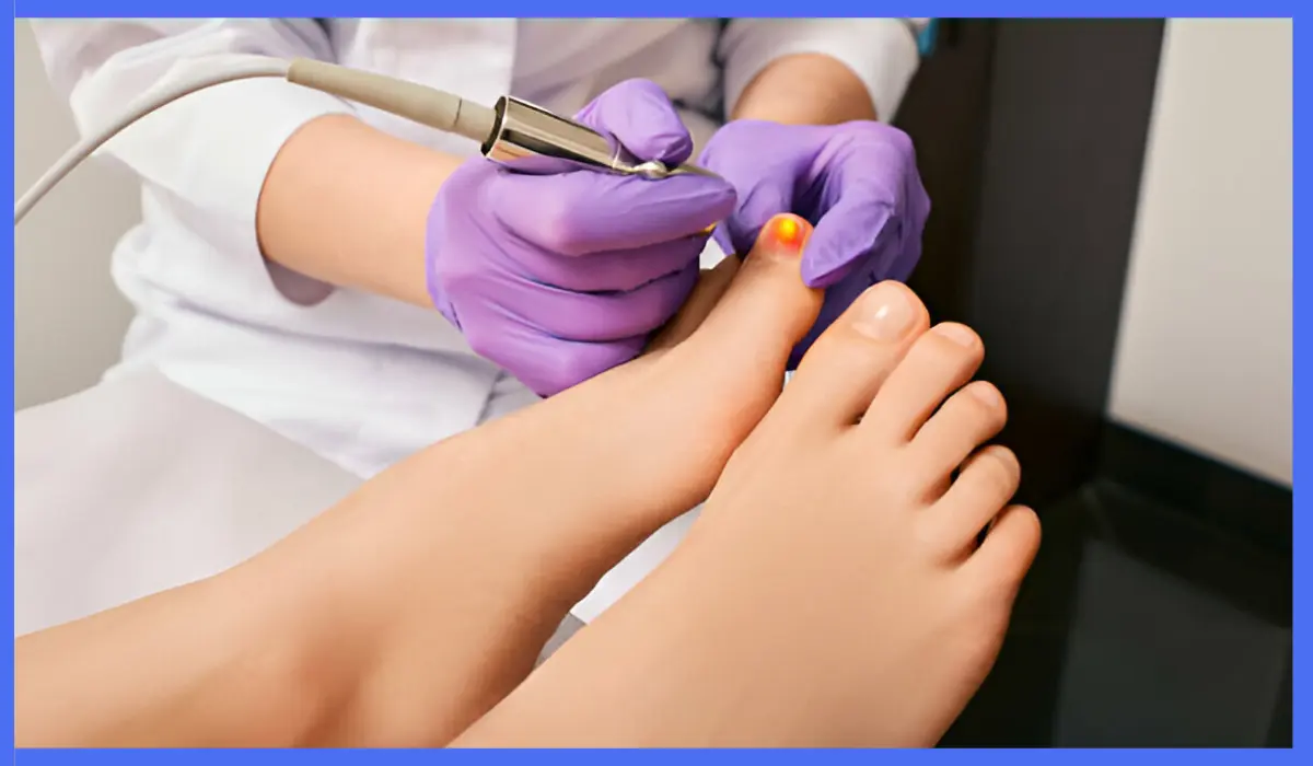 Laser Treatment For Toenail Fungus