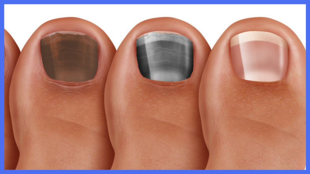 What Causes Discoloration of Nails: Understanding Nail Color Changes