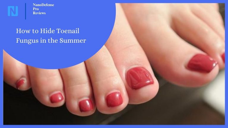 How to Hide Toenail Fungus in the Summer: Tips for a Confident Season