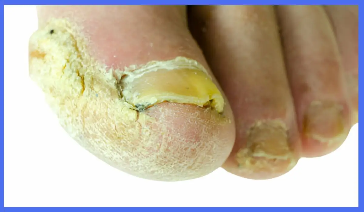 Risk Of Spreading Toenail Fungus