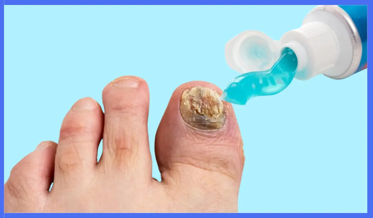 Toothpaste On Toenail Fungus