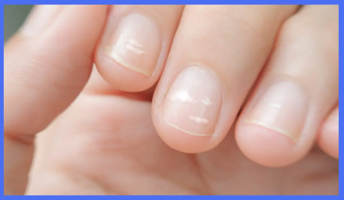 Vitamin Deficiency In Nail Health Chart