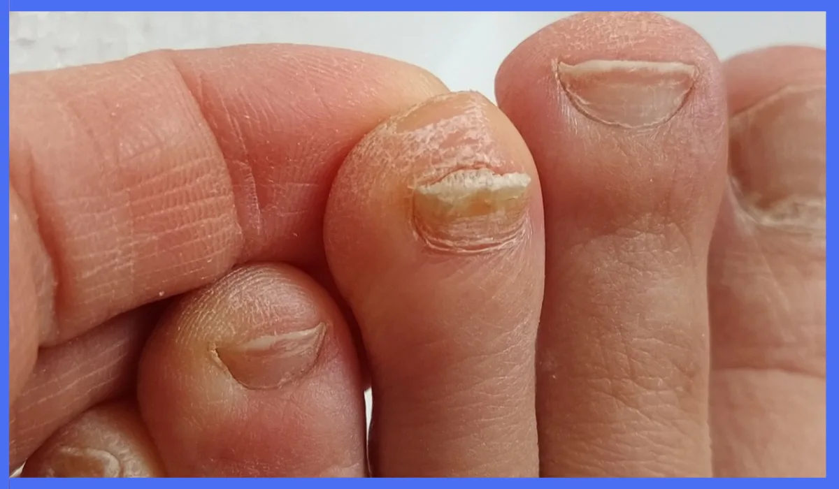 what kills toenail fungus permanently