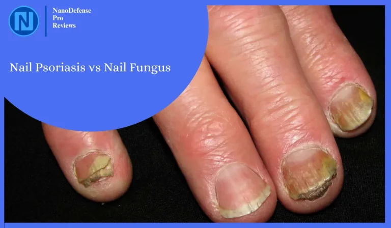 How To Distinguish Nail Psoriasis vs Nail Fungus? 7 Key Differences!