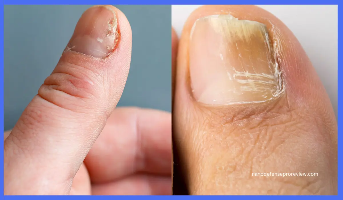 Nail psoriasis vs fungus