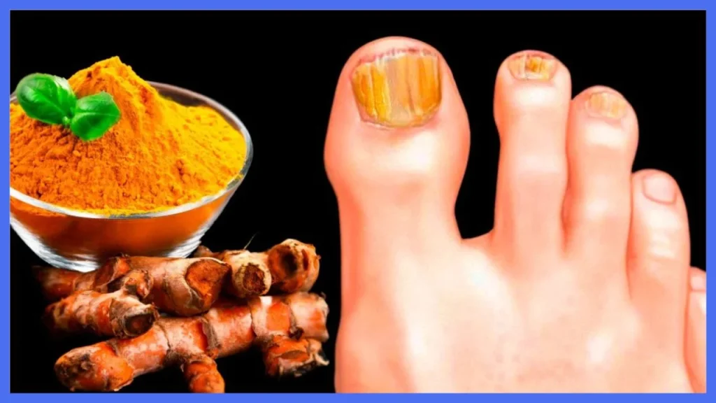 Turmeric for Nail Fungus