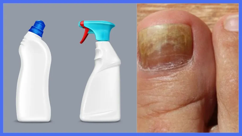 does bleach kill nail fungus