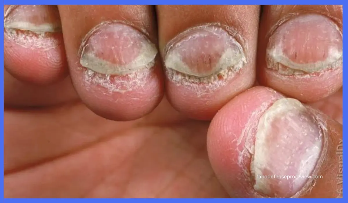 Treating Plaque Psoriasis Nails