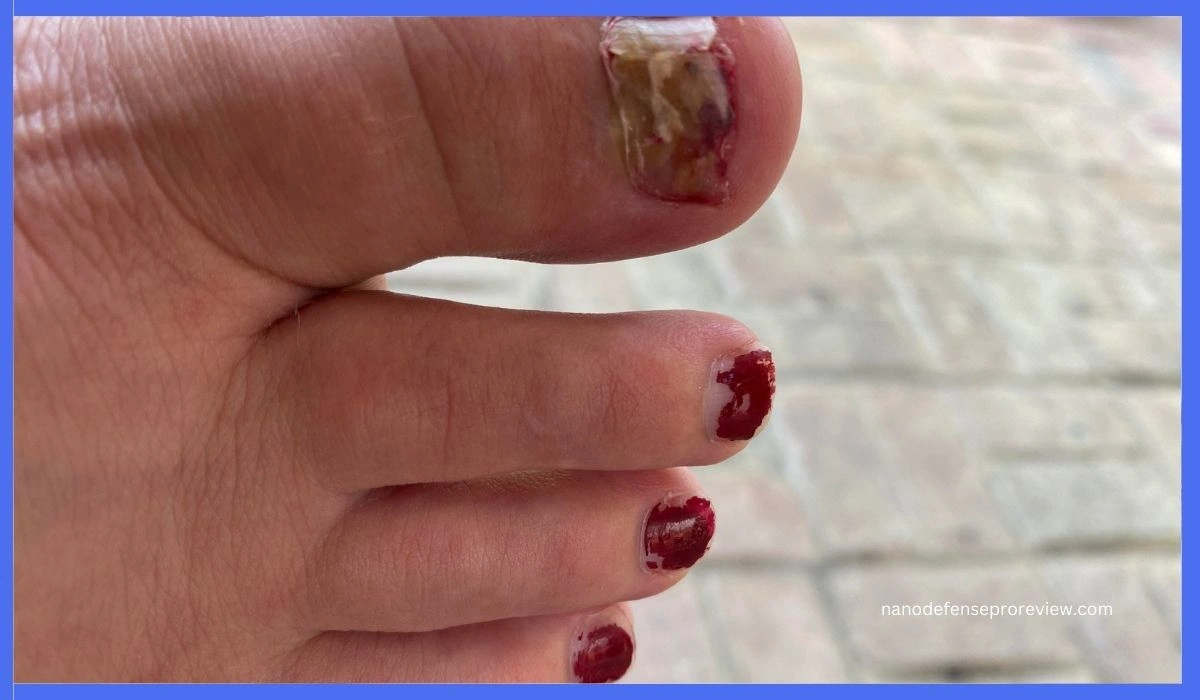 how to use eucalyptus oil for nail fungus